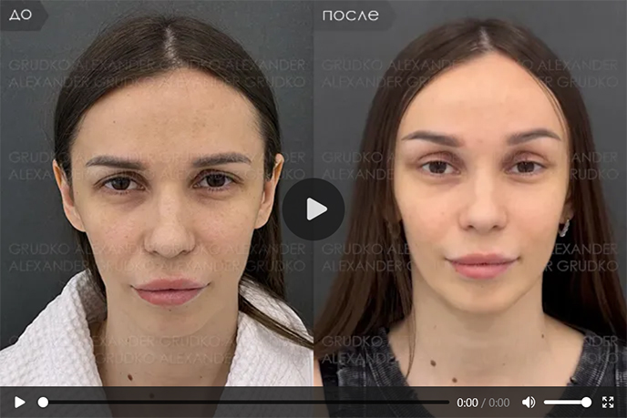 Фото до и после эндоскопической подтяжки лба и бровей