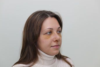 3й день после ринопластики