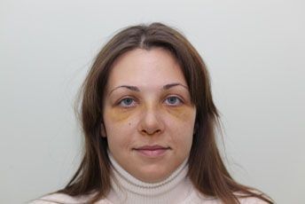 3й день после ринопластики