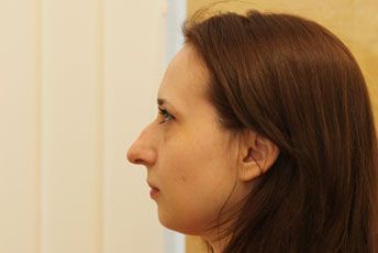фото до ринопластики, пластический хирург Грудько Александр Викторович