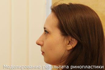 моделирование результата ринопластики, пластический хирург Грудько Александр Викторович