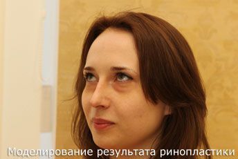 моделирование результата ринопластики, пластический хирург Грудько Александр Викторович
